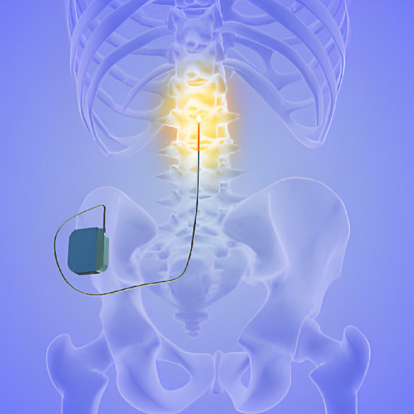 Spinal Cord Stimulation