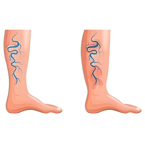 Chronic Venous Insufficiency