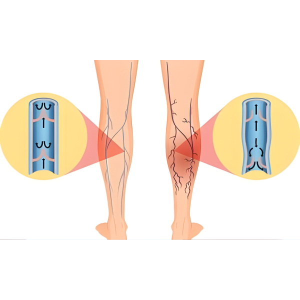 Varicose Treatments