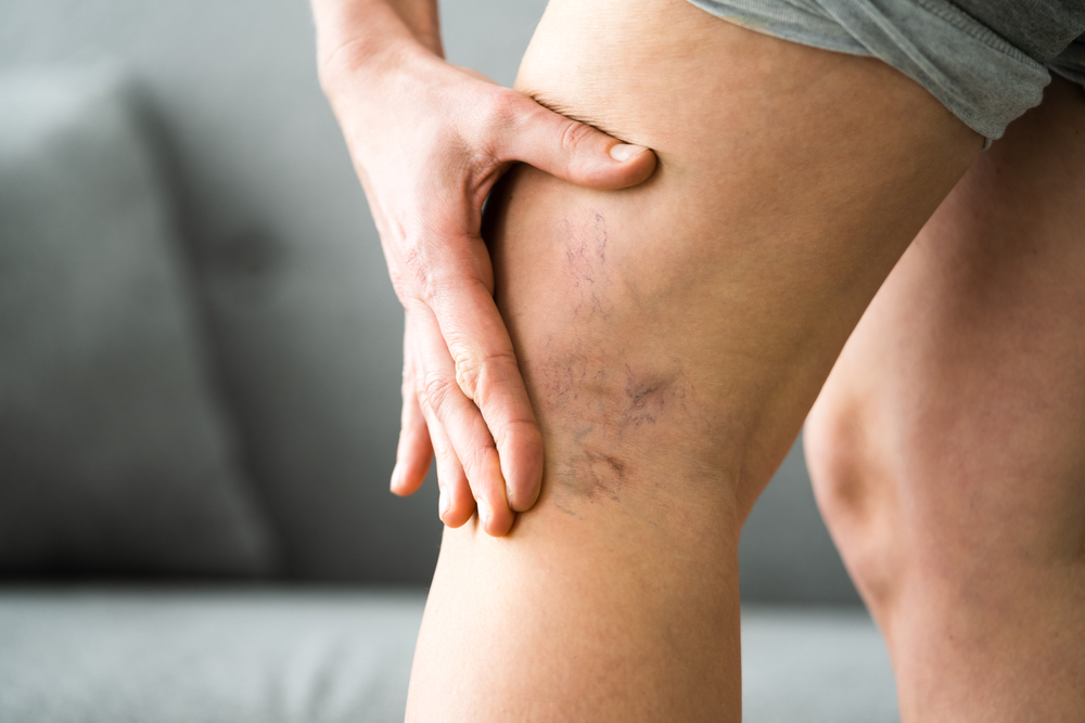 Expert Vein Care in Lincoln Park, New Jersey: Discover Relevium Pain & Vein