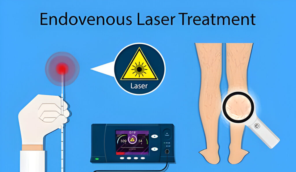 Endovenous Laser Treatment (EVLT)