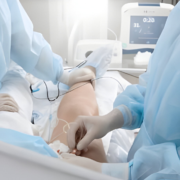 Radiofrequency Ablation for Veins