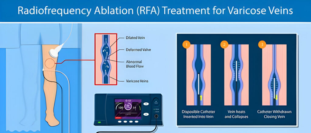 Radiofrequency Ablation for Veins