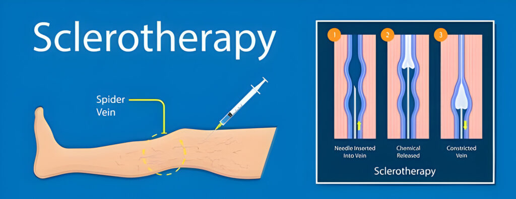 Sclerotherapy