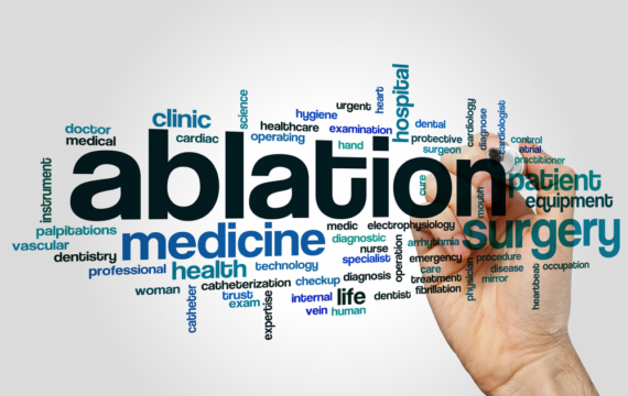 Say Goodbye to Varicose Veins with Ablation