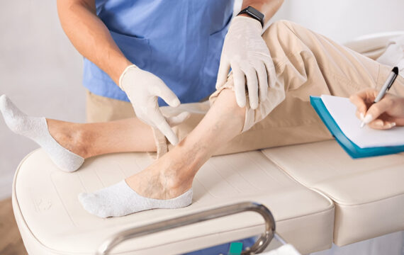 Leg Veins Got You Down? Signs You Need a Top-Rated Vein Specialist