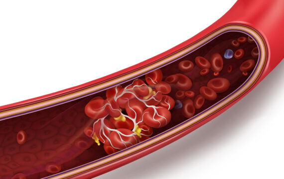 Blood Clot Check? Understanding Your Leg Ultrasound