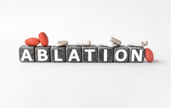 Maximizing Your Recovery Post Vein Ablation