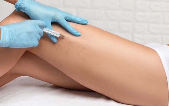 Everything You Need to Know About Sclerotherapy