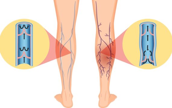 Identify Your Varicose Veins