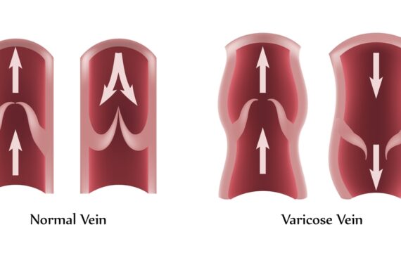 What Happens if Your Leg Vein Valves Are Weak?