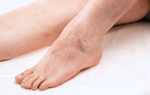 Can Walking Reverse Venous Insufficiency?