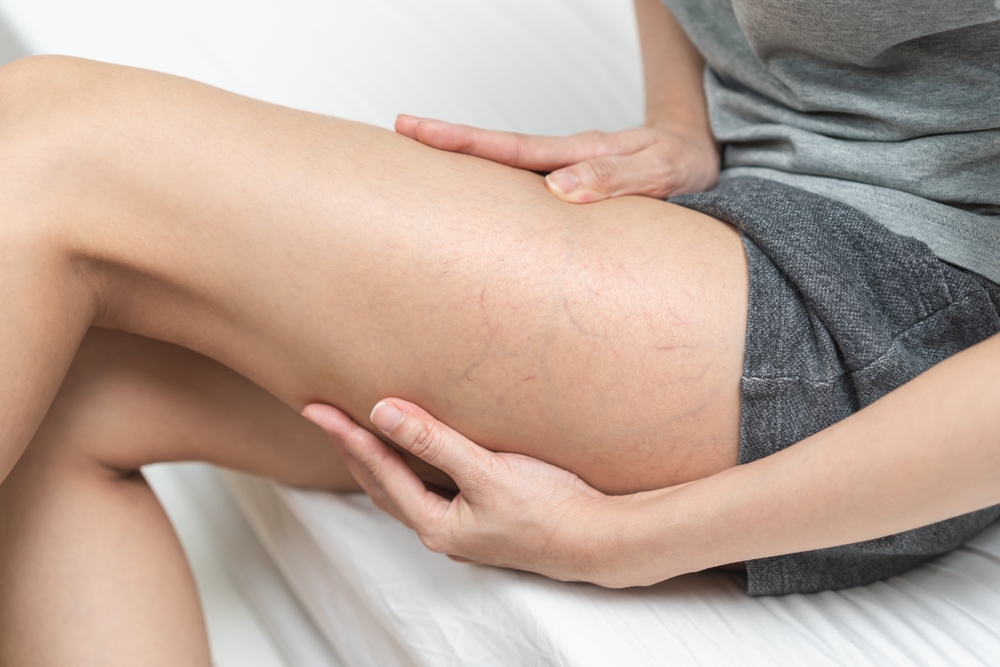 Say Goodbye To Spider Veins With Complete Removal Relevium Pain Vein