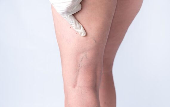 Spider Vein Treatment: Before and After