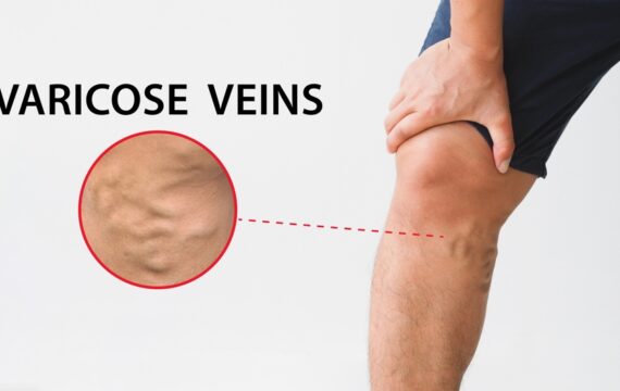 Restore Your Confidence: Eliminate Varicose Veins