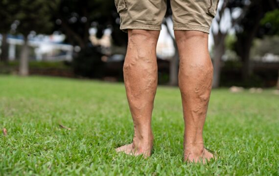 What Type of Varicose Veins Do I Have?