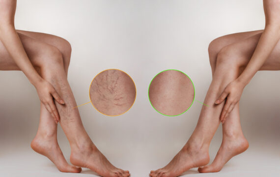 What Causes Varicose Veins to Appear?