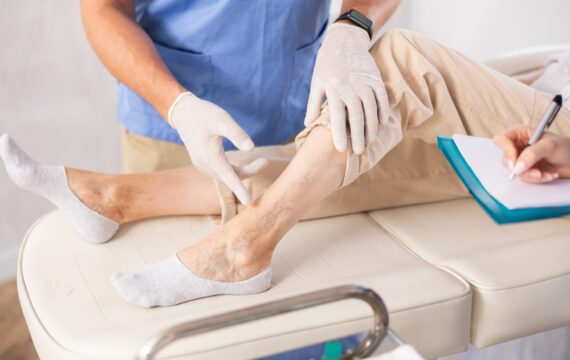 Does Sclerotherapy Require Multiple Sessions?